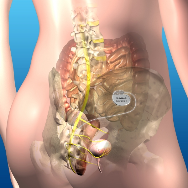 Sacral Nerve Stimulation (SNS) - Bowel / Faecal Incontinence